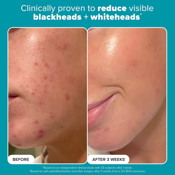 Paulas choice 2% BHA toner